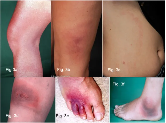 Figure 3: Variability of the erythema migrans