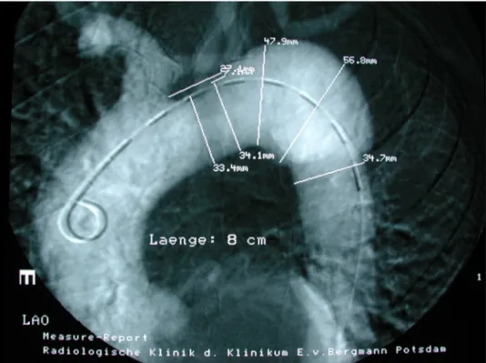 Figure 1: Pre-operative angiography of the aneurysm site with diameters of the aneurysm and adjacent zones, catheter inside aortic lumen