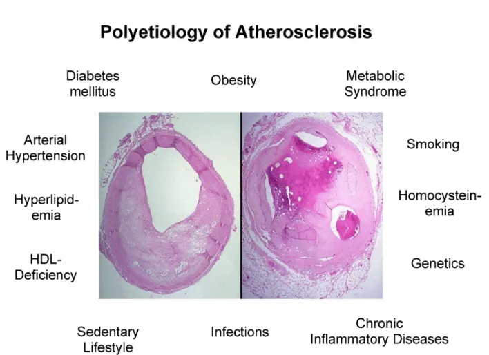 Figure 1: Polyetiology of atherosclerosis: Histology of different states of obstructing atherogenesis surrounded by the known risk factors