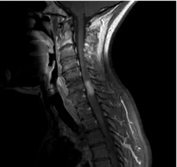 Figure 1: MRI of the cervical spine, sagittal view: contrast enhancement in the lower cervical cord