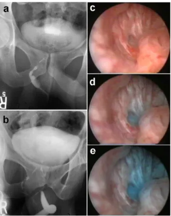Figure 1: (a) Appearance of accessory urethra on fistulography and (b) on voiding cystography; (c, d, e) methylene blue flow, which was injected into the perianal fistula, was seen in the