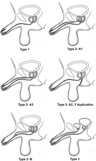 Figure 3: Classification of urethral duplication proposed by Effmann et al. [1]