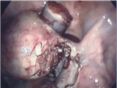 Figure 2: The cornual pregnancy excised and stored in the anterior cul-de-sac