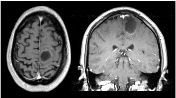 Figure 1: MRI of the brain showing a 2.9 x 2.5 x 2.3 cm hypointense mass in the left superior medial frontal lobe with minimal peripheral enhancement