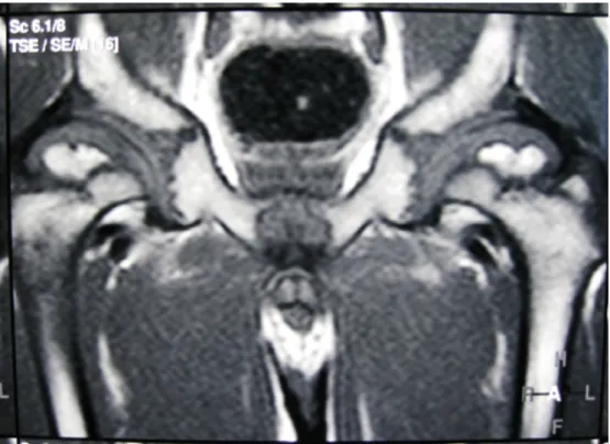 Figure 4: MRI image showed defective ossification of the femoral heads confirmed the superolateral femoral head collapse (a feature of progressive dysplasia and severe joint degeneration) associated with femoral head osteonecrosis (note the medial