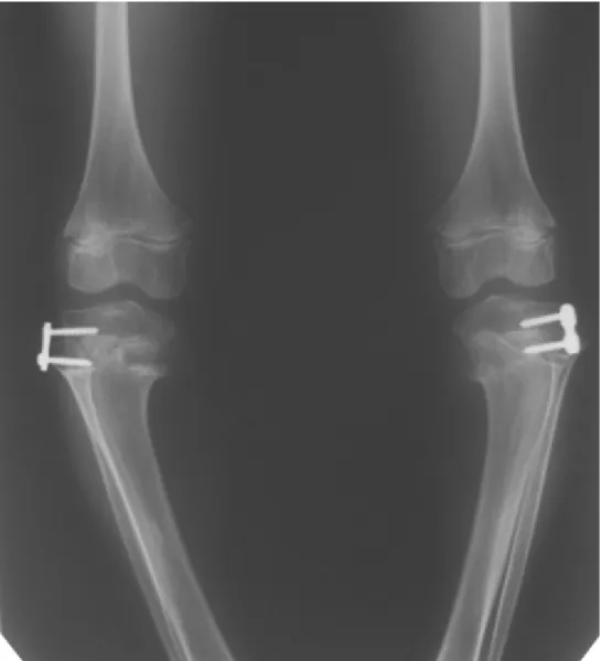 Figure 6: Anteroposterior standing radiograph of the knee joints, 3 months after temporary lateral hemiepyphyseodesis of both tibiae