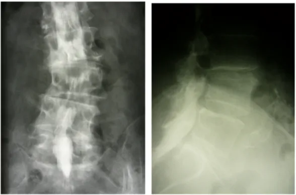 Figure 1: Exemplary preoperative X-ray of a degenerative spinal stenosis and instability