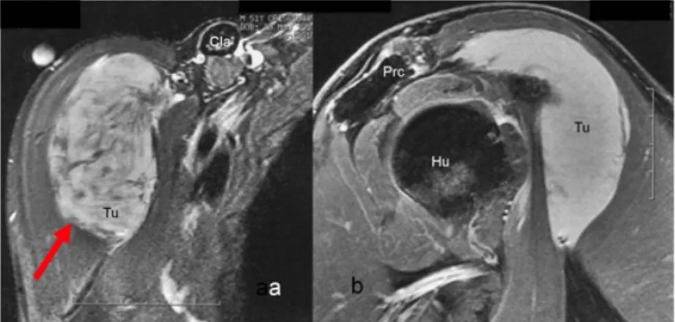 Figure 1: Preoperative MRI of the right shoulder showing the tumor a) in transverse cross-section with Tumor (Tu/arrow) 8x6x3.5 cm, Clavicle (Cla) and b) in relation to neighboring structures such as Humerus (Hu), Processus coracoideus (Prc).