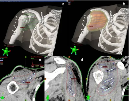 Figure 4: a–e) Brachytherapy dose distribution on the 2D and 3D level.