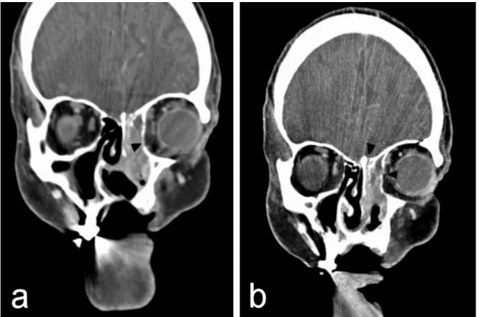 Figure 2: Coronal CT scans showing (a) a lobulated tumor in the left nasal cavity and ethmoid sinus with extension to the periorbita (black arrow)