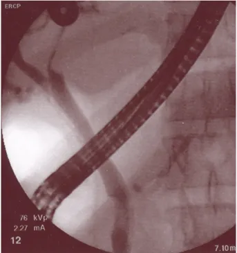 Figure 1: ERCP showing filling defect at lower end of CBD