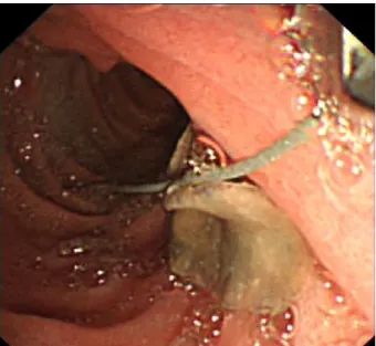 Figure 3: Complete extraction of Fasciola in duodenum by ERCP