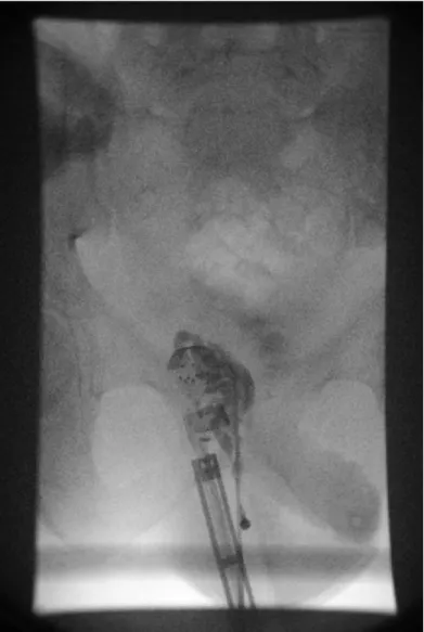 Figure 1: Transrectal injection of contrast-agent into the right seminal vesicle confirms correct location of needle