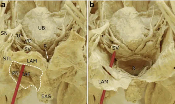 Figure 4: Anatomical preparation of the transcutaneous course of puncture to the seminal vesicles used for the CT- or MR- MR-guided balloon dilation of the ejaculatory ducts