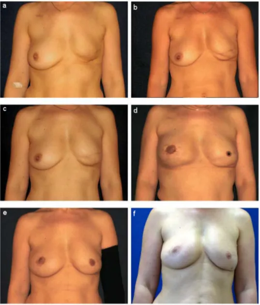 Figure 6: 56-year-old patient after total mastectomy left side in 2006. Outcome after 3 months (a) 300 ml grafted in P1, (b) 250 ml in P2