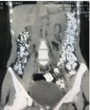 Figure 1: CT scan of the abdomen showing diffuse colonic calcification