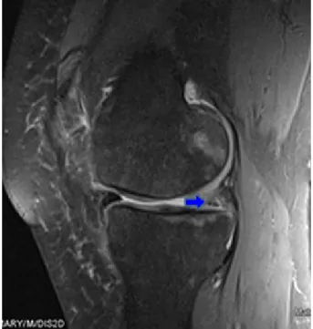 Figure 1: Sagittal T1-weighted MRI of the left knee shows no attachment of the posterior horn of the medial meniscus to the tibial plateau, but instead the meniscofemoral ligament (ligament of Wrisberg) joins the posterior horn of the meniscus