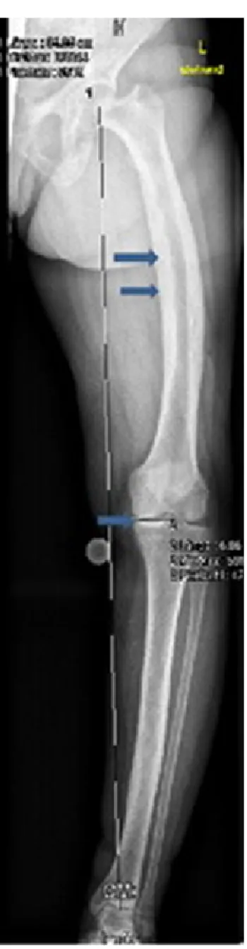 Figure 2: Weight bearing anteroposterior left lower limb radiograph shows varus deformity of the left lower extremity and narrowing of the medial knee joint and narrowing of the hip joint as well associated with unusual cortical thickening and bone enlarge