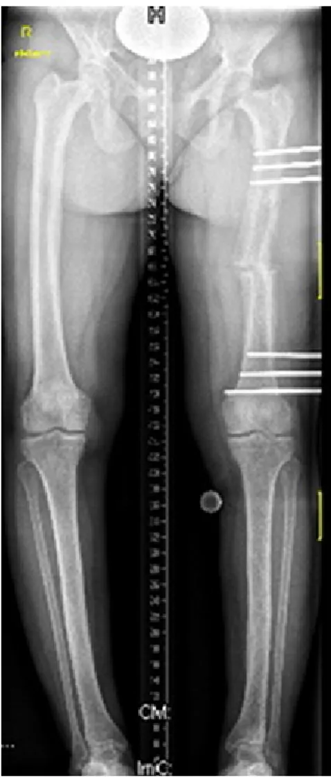 Figure 5: Six months postoperative radiograph showed that complete healing was accomplished, and the fixator was