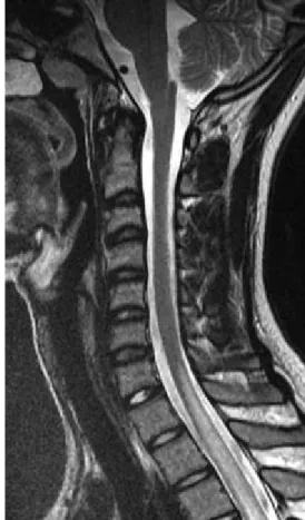 Figure 3: MRI spine showing hyperintensity in cervical cord C5 to C7 level (3)