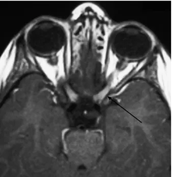Figure 7: MRI brain showing hyperintensity in the right optic nerve head