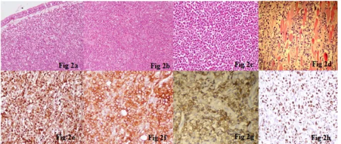 Figure 2: a: Photomicrograph showing sheets of immature cells admixed with interspersed mature inflammatory cells including eosinophils and their precursors (H&amp;E, x 200)