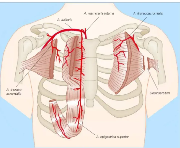 Figure 3: Options for flap coverage using the pectoralis major muscle