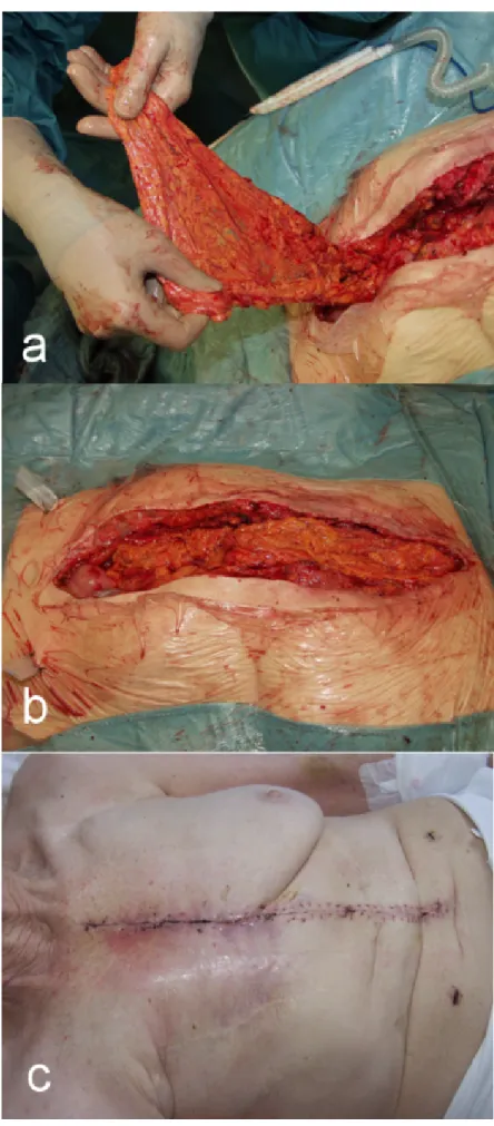Figure 4a: Intraoperative omentum pull-up; b: Greater omentum transponated into the defect; c: 12 days postoperatively (Pat.