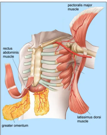Figure 5: Flap-plasty options at the front wall of the thorax In addition to the increased logistic challenge for some hospitals, the following complications after muscle  flap-plasties have to be taken into consideration.