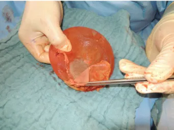 Figure 3: Prosthesis removed from a a patient with grade IV Baker capsular contracture and firm attachment of capsule