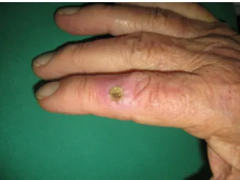 Figure 1: Grade IV pressure ulcer of the right index finger