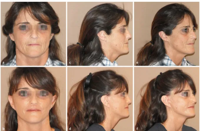 Figure 1: Young patient requesting a facelift, pre- (a, c, e) and postoperative view (b, d, f)