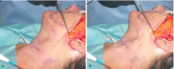 Figure 6: Relaxed (a) and tentioned (b) ‘fourth suture’ and its impact on the medial neck