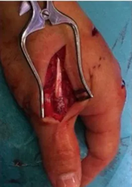 Figure 2: Restoration of thumb extension by extensor indicis proprius tendon transfer using SSTS technique