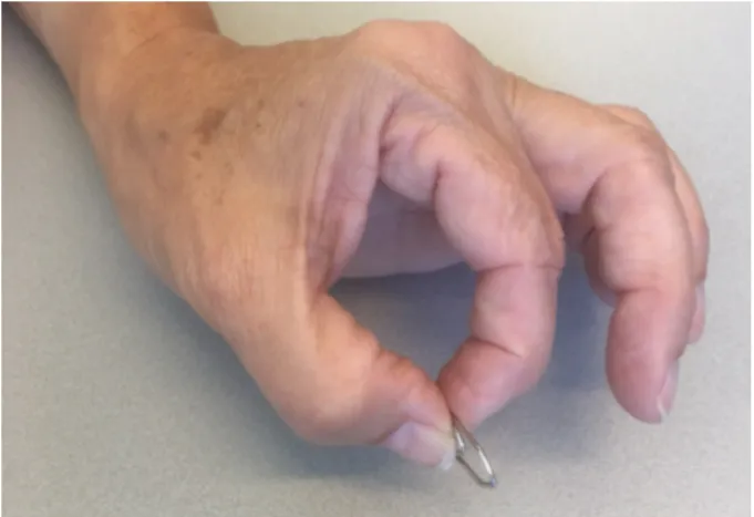 Figure 1: Incomplete O (or circle) sign due to paralysis of the FPL, yet preserved distal interphalangeal flexion of the index