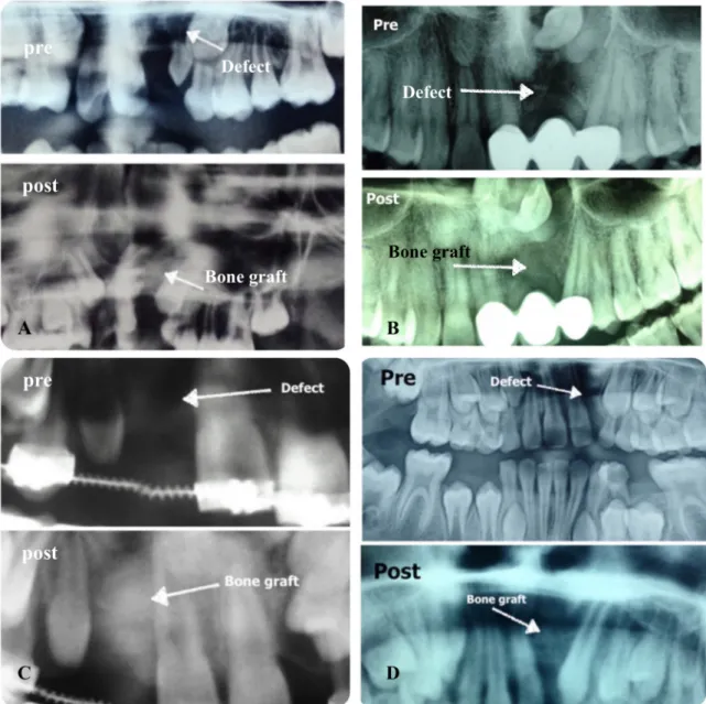 Figure 5: Pre- and postoperative radiographs of some cases. A: ICBG was used, B and C: ASCs/ICBG was used, D: ASCs/DBM was used.