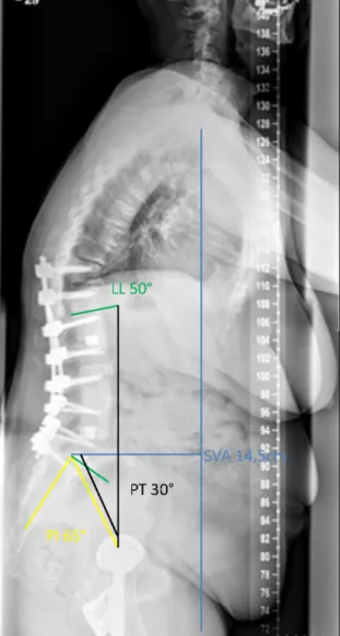Figure 1: Whole spine X-ray, lateral view. The sagittal profile is imbalanced: C7 plumb line in front of the hips (SVA 14,5 cm), Pelvic incidence 65°, lumbar lordosis 50°.