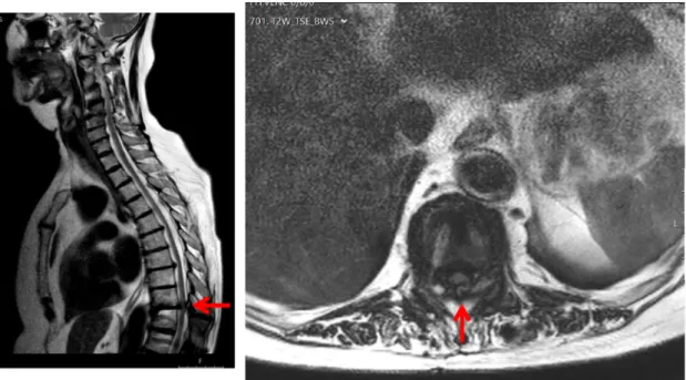 Figure 2: Left: T2-weighted sagittal MRI. Pincer stenosis Th 10/11 (arrow). Right: T2-weighted transverse MRI.