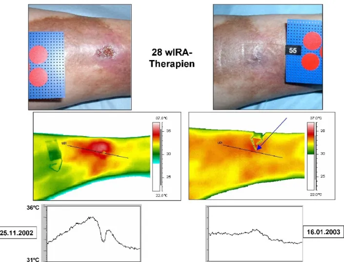 Abbildung 3: Beispiel für einen Heilungsverlauf eines chronischen venösen Unterschenkel-Ulkus unter Therapie mit wIRA (28mal 30 Minuten Bestrahlung mit sichtbarem Licht (VIS) und wassergefiltertem Infrarot A (wIRA) innerhalb von 52 Tagen = ca.