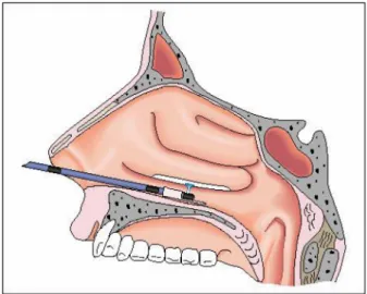 Figure 8: APC in the nasal cavity, where a probe with lateral outlet is used