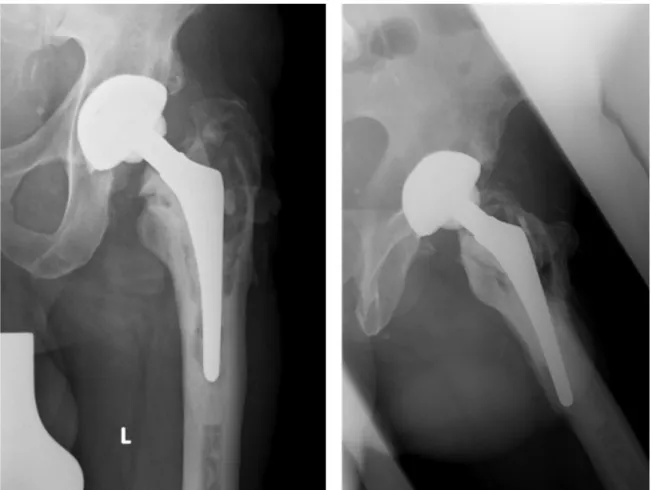 Figure 3: Chronically septic loosening of a cemented hip stem with extended osteolyses, breakage of the cement mantle and migration of the total hip stem