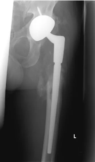 Figure 4: Cementless total hip revision implant: radiological follow-up 1 year after implantation