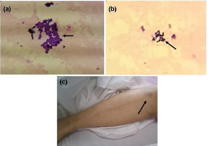 Figure 1: (a), (b) Positive Malassezia species from synovial fluid in direct smear with gram staining