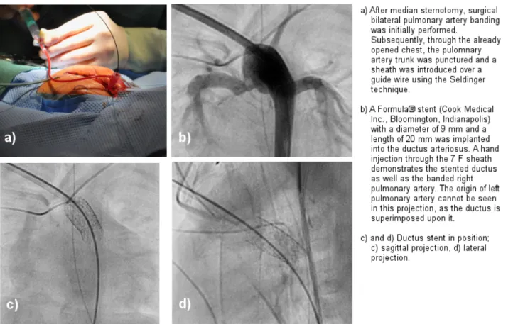 Figure 4: Combined pediatric-cardiac-surgical and catheter-interventional procedure in a hypotrophic newborn baby (body weight 2 kg) with hypopolastic left heart syndrome