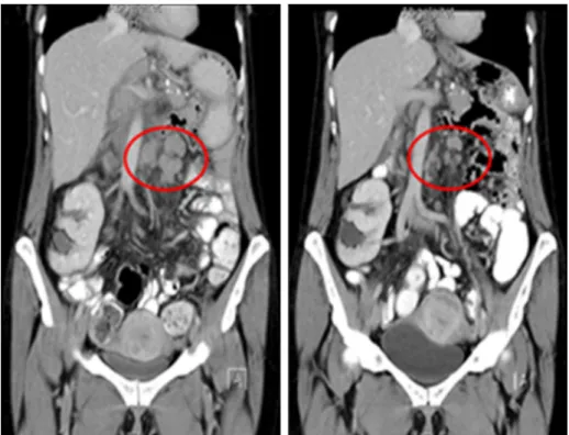 Abbildung 2: Ergebnis der radiologischen Verlaufskontrolle (CT-Abdomen) bei Patientin Nr