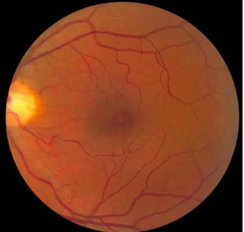 Figure 2: Fundus photography of the left eye. Refractile deposits are seen in the macular region.
