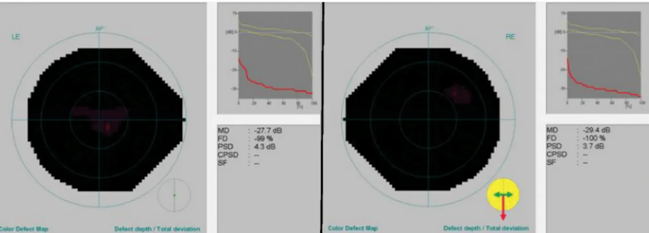 Figure 1: Automated perimetry at presentation demonstrating severely disturbed central visual fields (RE: right eye, LE: left eye).