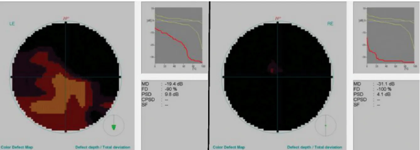 Figure 3: Eleven days after surgery, automated perimetry revealed a marked improvement in the left eye (RE: right eye, LE: left eye).