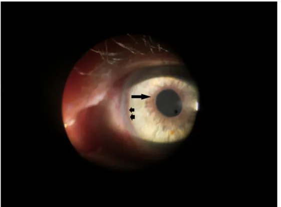 Figure 1: Slit lamp biomicroscopy of the anterior segment of the left eye shows marginal (arrow) and peripheral (arrowheads) circumferential neovascularization of the iris.