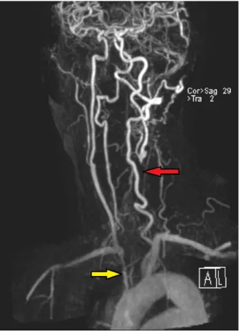 Figure 4: MRA extracranial showing severe narrowing of the origin of the right brachiocephalic artery (yellow arrow) and complete occlusion of the left common carotid artery with distal reconstitution of flow near the bifurcation (red arrow).